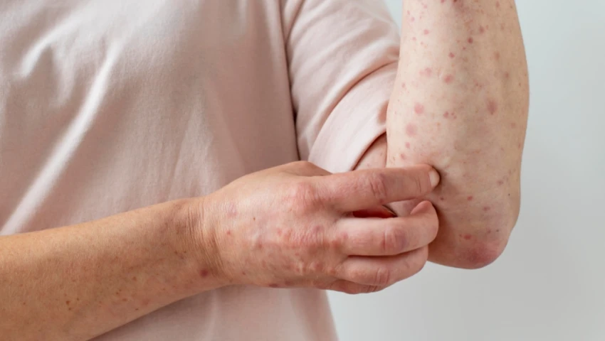 sarampión estados casos confirmados